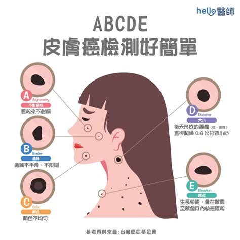 痣怎麼來的|痣變大、痣多或長毛會變皮膚癌？認識痣的形成與原因